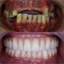 Dentadura Temporária Ajustável em Silicone Flexível
