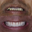 Dentadura Temporária Ajustável em Silicone Flexível
